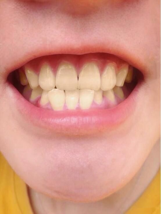 牙齿从黄变白经历分享
