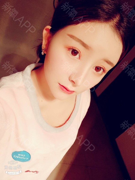 【下眼下至术后37天】嘿,各位宝宝们,最近这段时间_圈子-新氧美容整形