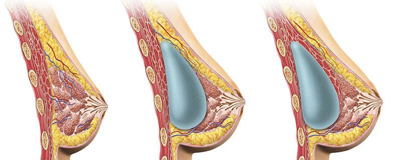 假体隆胸有后遗症?