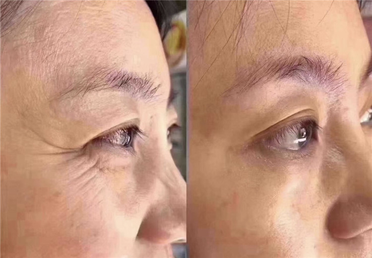 保妥适除皱怎么样