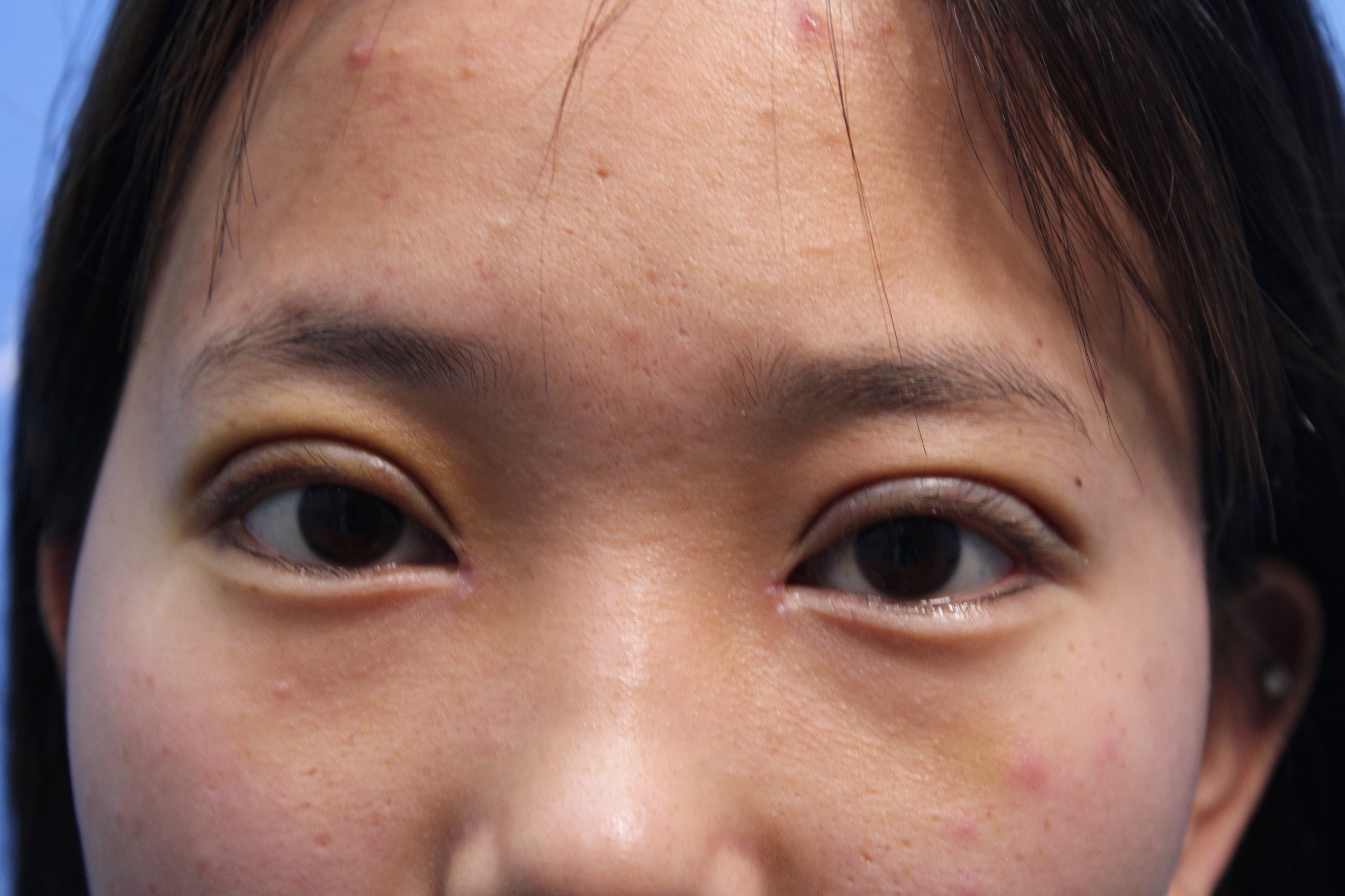 【术后7天拆线】双眼皮术后肿胀是正常的,尤其是术后_圈子-新氧美容