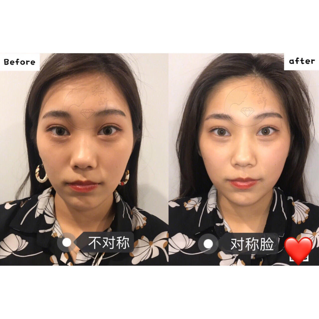 悉尼日式徒手美骨小v脸美骨术