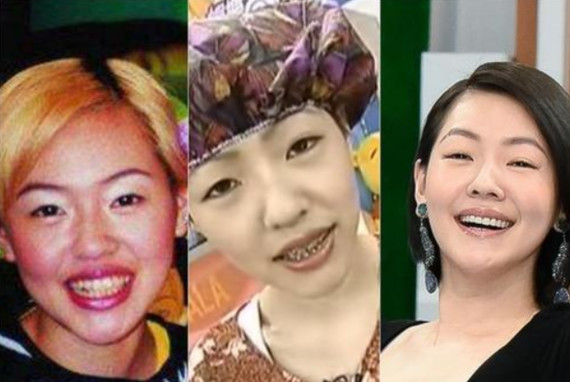 比如没有整牙前的小s,脸部骨骼没有任何问题,只是龅牙而已