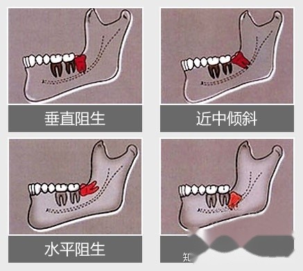 73智齿学名第三磨牙,一般来讲每人嘴里零至四颗不