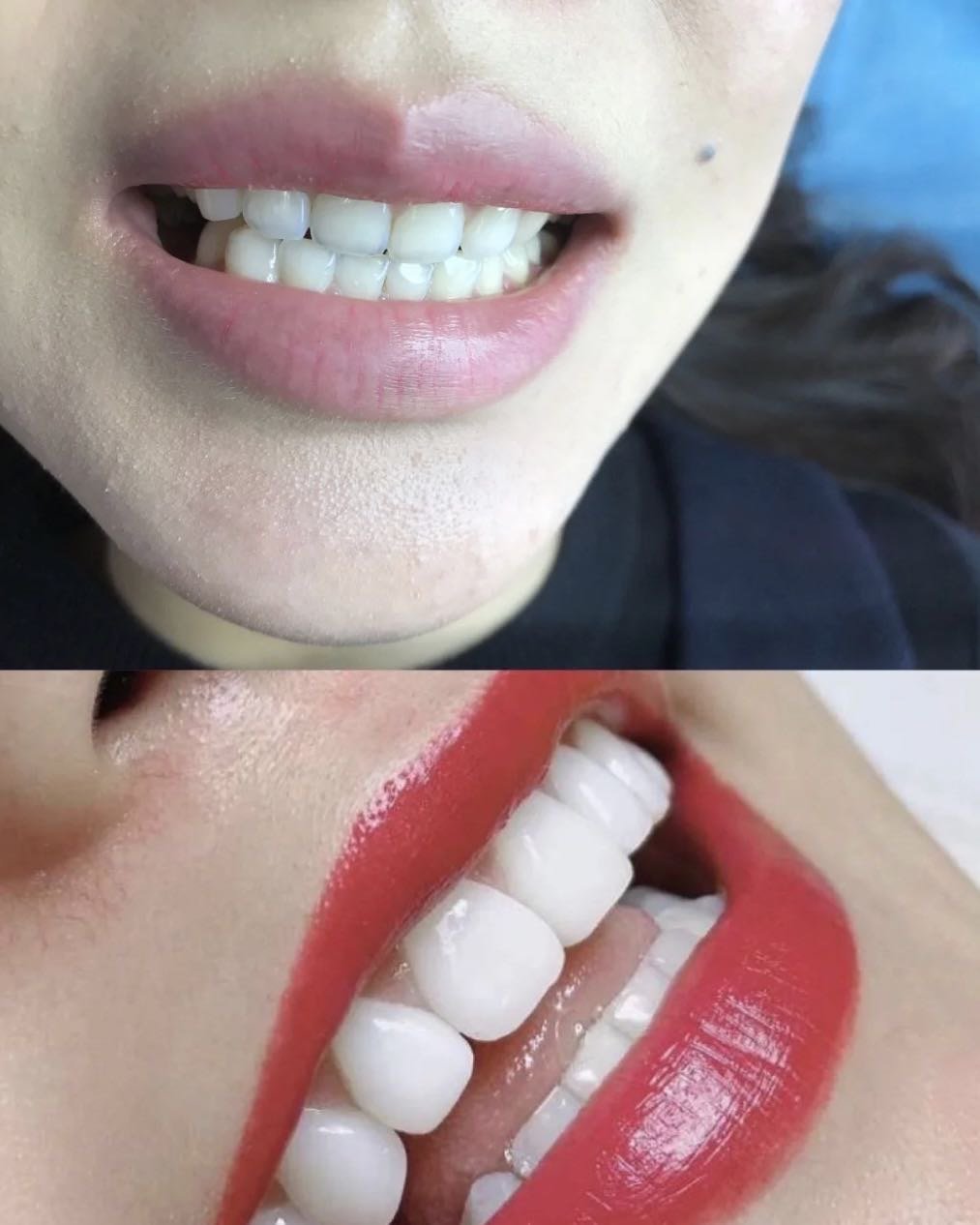 脸部微笑线养成标准笑容是怎么样的?