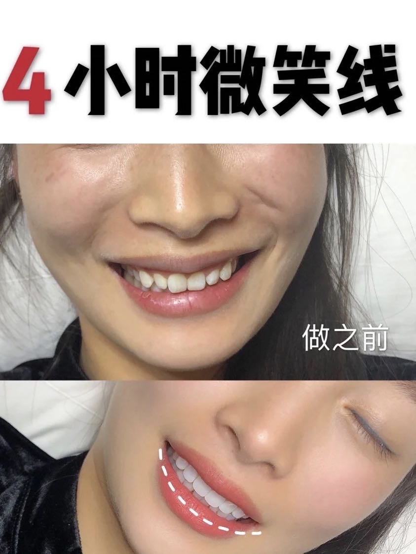 脸部微笑线养成标准笑容是怎么样的?