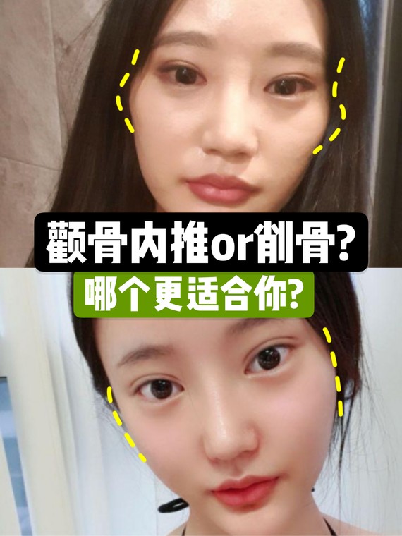 现在去韩国削颧骨需要多少钱 韩国原辰 Id Faceline三家医院价格对比给你看 整形行业新闻话题 美佳网