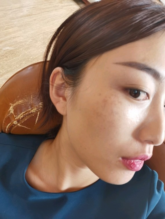 第二次皮秒反黑阶段