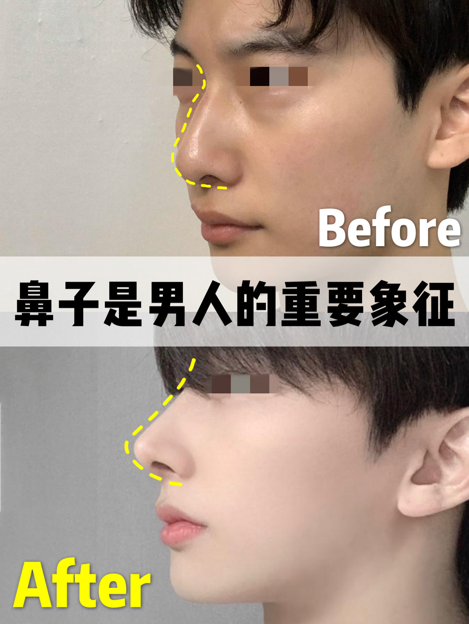 我是天生的驼峰鼻而且鼻尖也不翘这个鼻型让人显得凶其实我是个