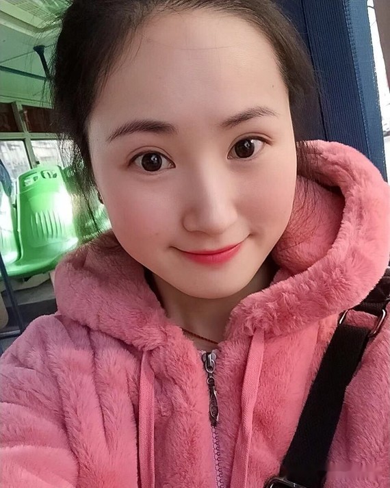 真的是越早做越美!本人今年35岁,带牙套一年_圈子-新氧美容整形