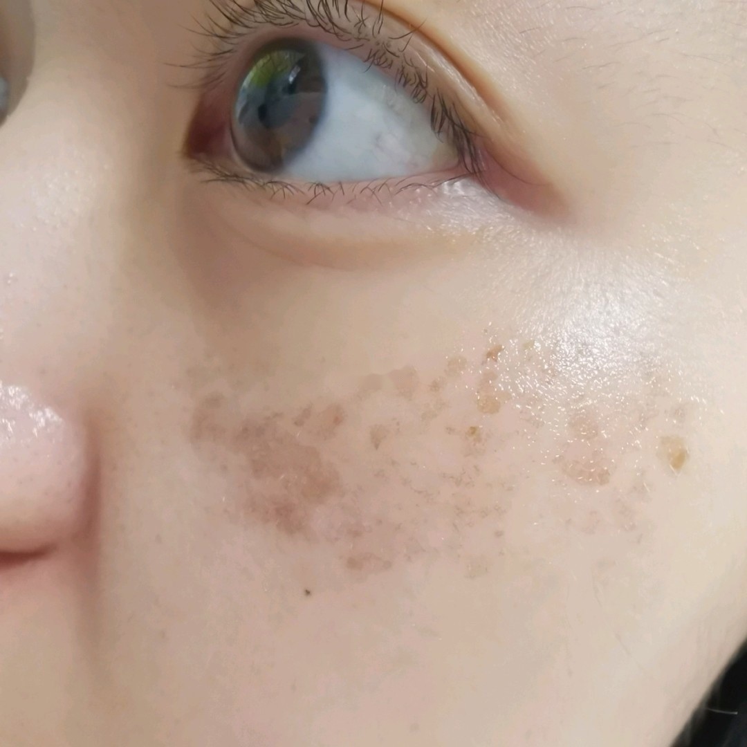 记录第二次皮秒去太田母痣 脸上有痣的女孩注意了,大家看看这个妹子