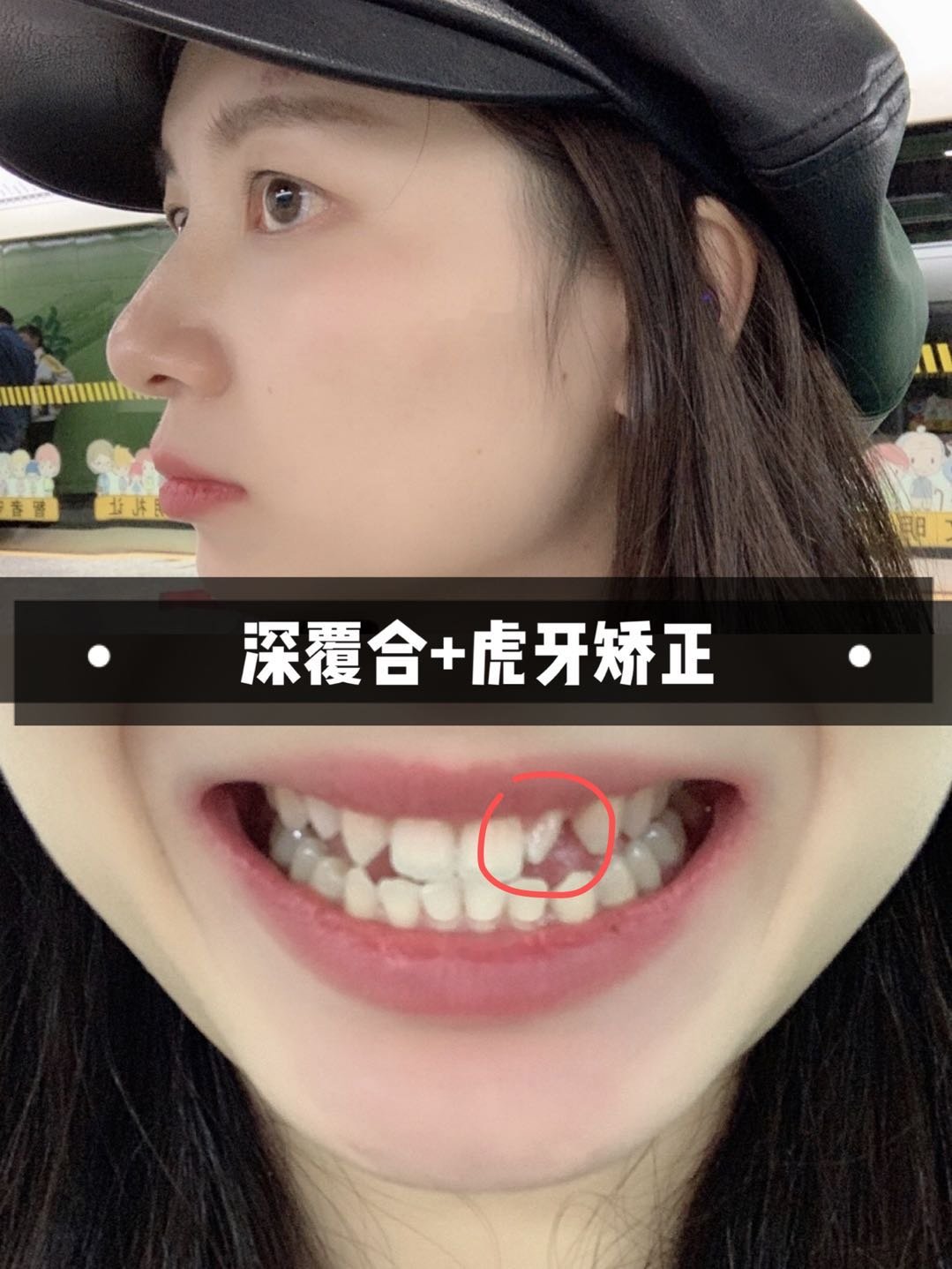 九院排到我了现在在等方案,深覆颌,侧切牙长歪了,还有2颗虎牙,有没有