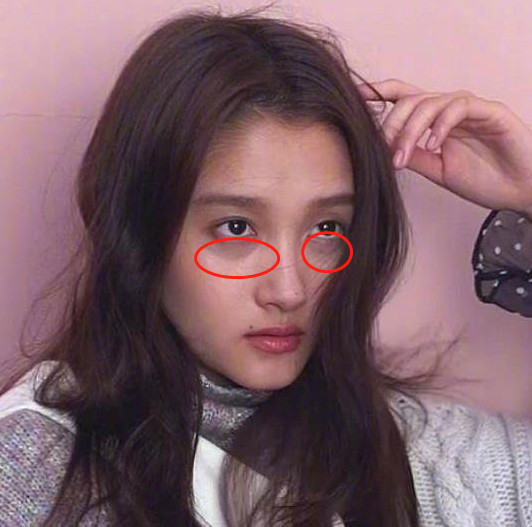 [【黑眼圈拯救计划】长的再美,经不住黑眼圈拉低颜值_圈子-新氧美容