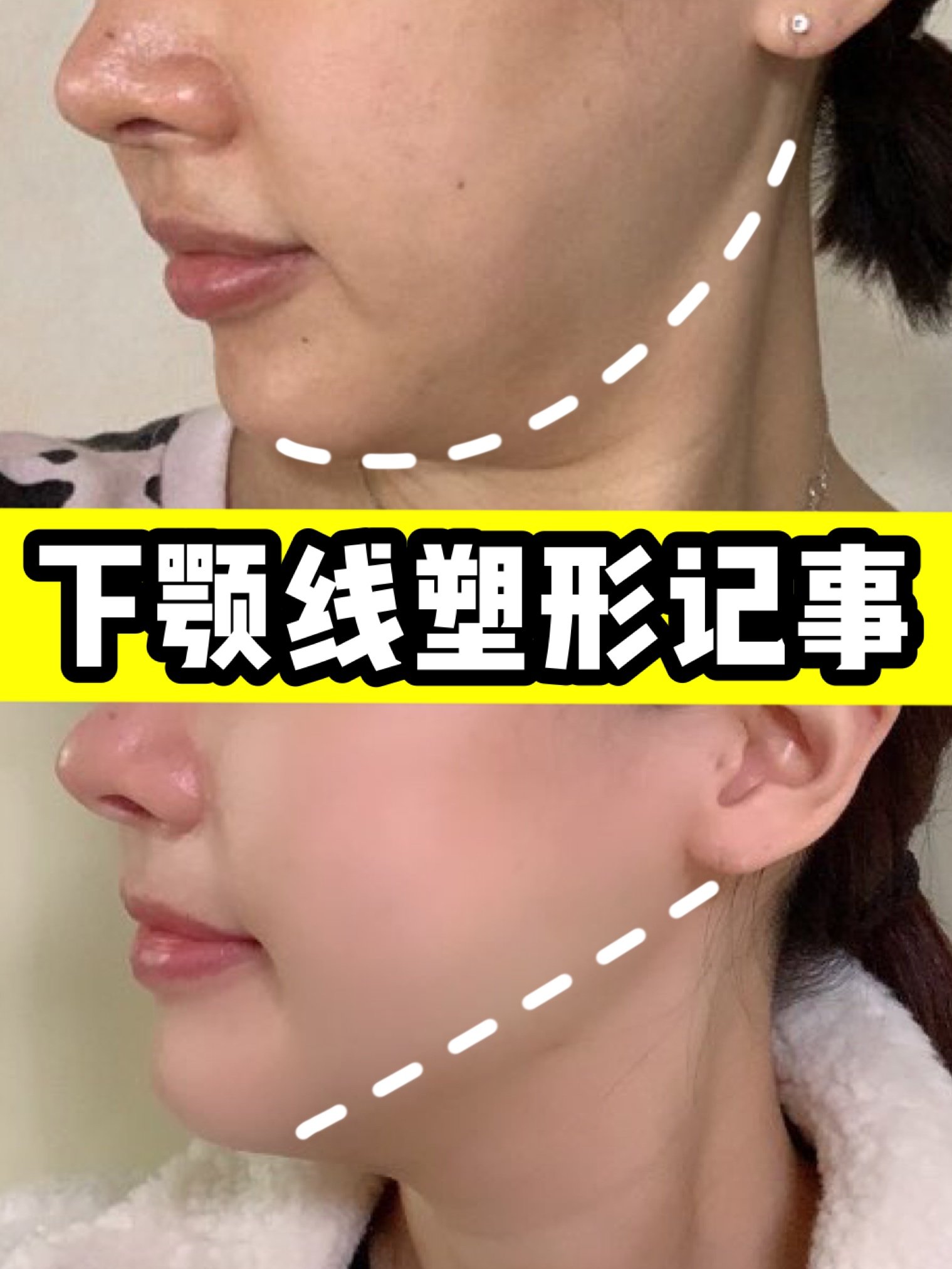 拯救下颚线计划,get紧致瘦脸