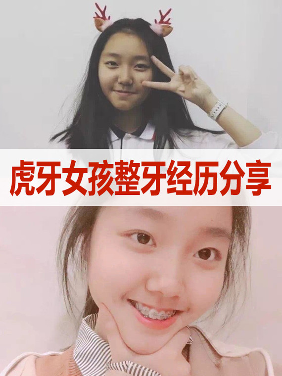 分享一个虎牙小姐姐走牙齿矫正的案例,给大家做参考哇~矫正进度:已