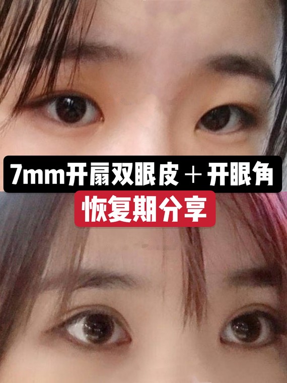 【投稿】双眼皮全切 开扇7mm开眼角,悄悄地变美了_圈子-新氧美容整形