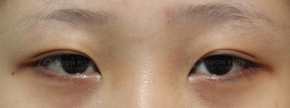 好多人觉得自己眼睛不够大,不好看,就想去割双眼放大_圈子-新氧美容