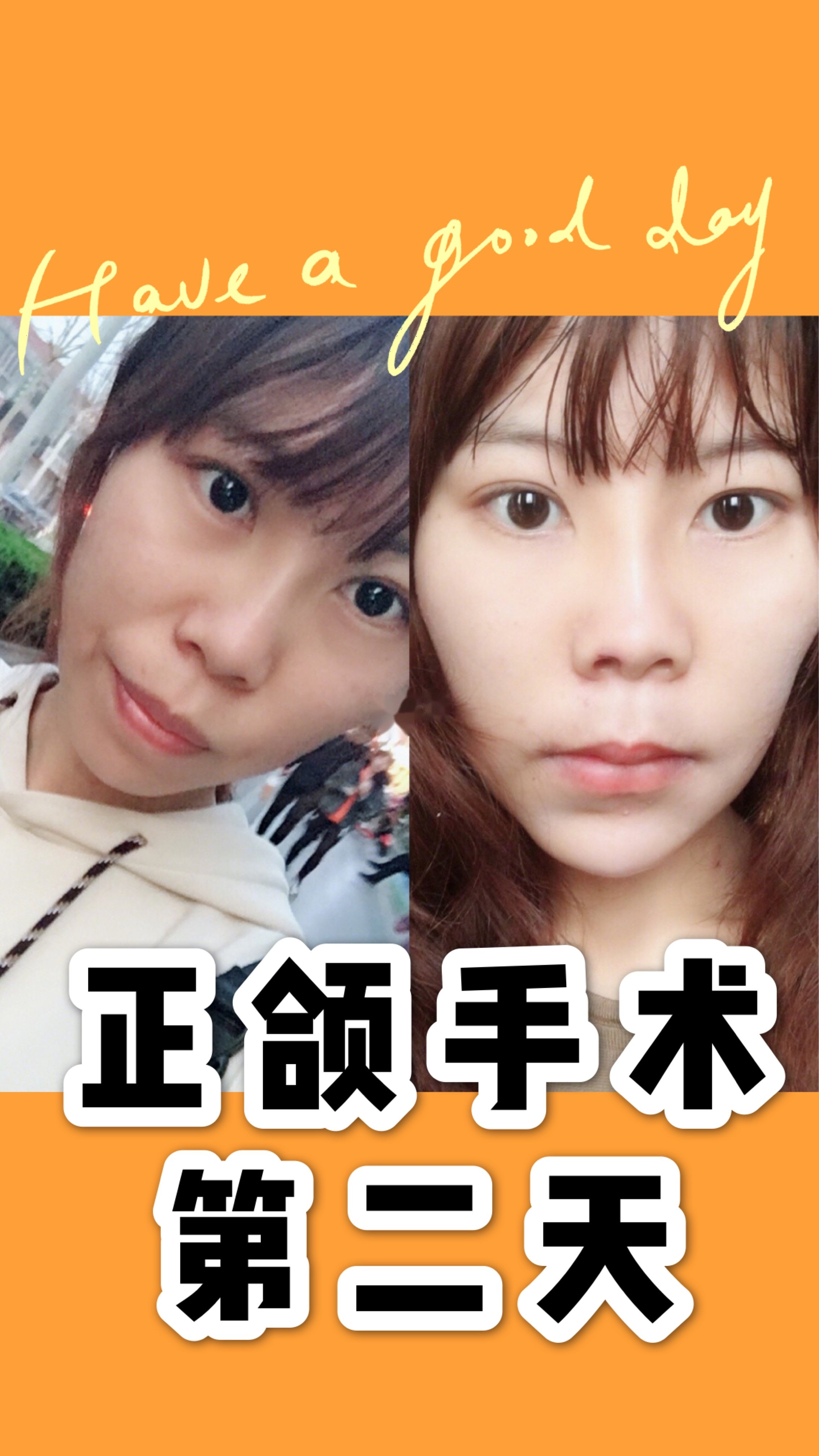 正颌手术出院第二天做了几张对比图左边是正颌前右边是_圈子-新氧美容