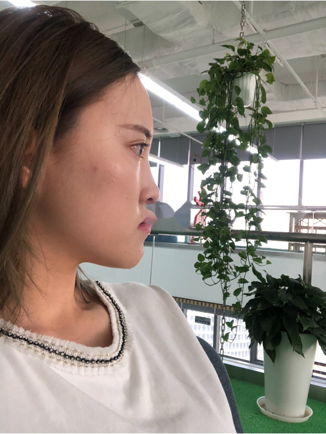 正颌术后70天,她的鼻孔朝天了?