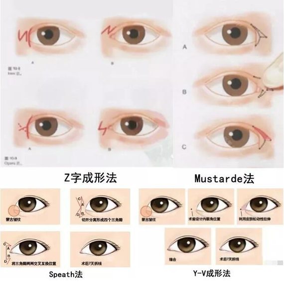 开内眼角手术是把多余的皮肤切掉,根据手术切口的不同有多种术式,即z
