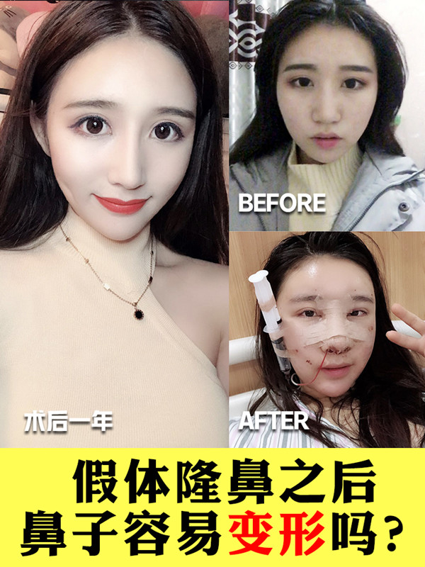 假体隆鼻之后鼻子容易变形吗?