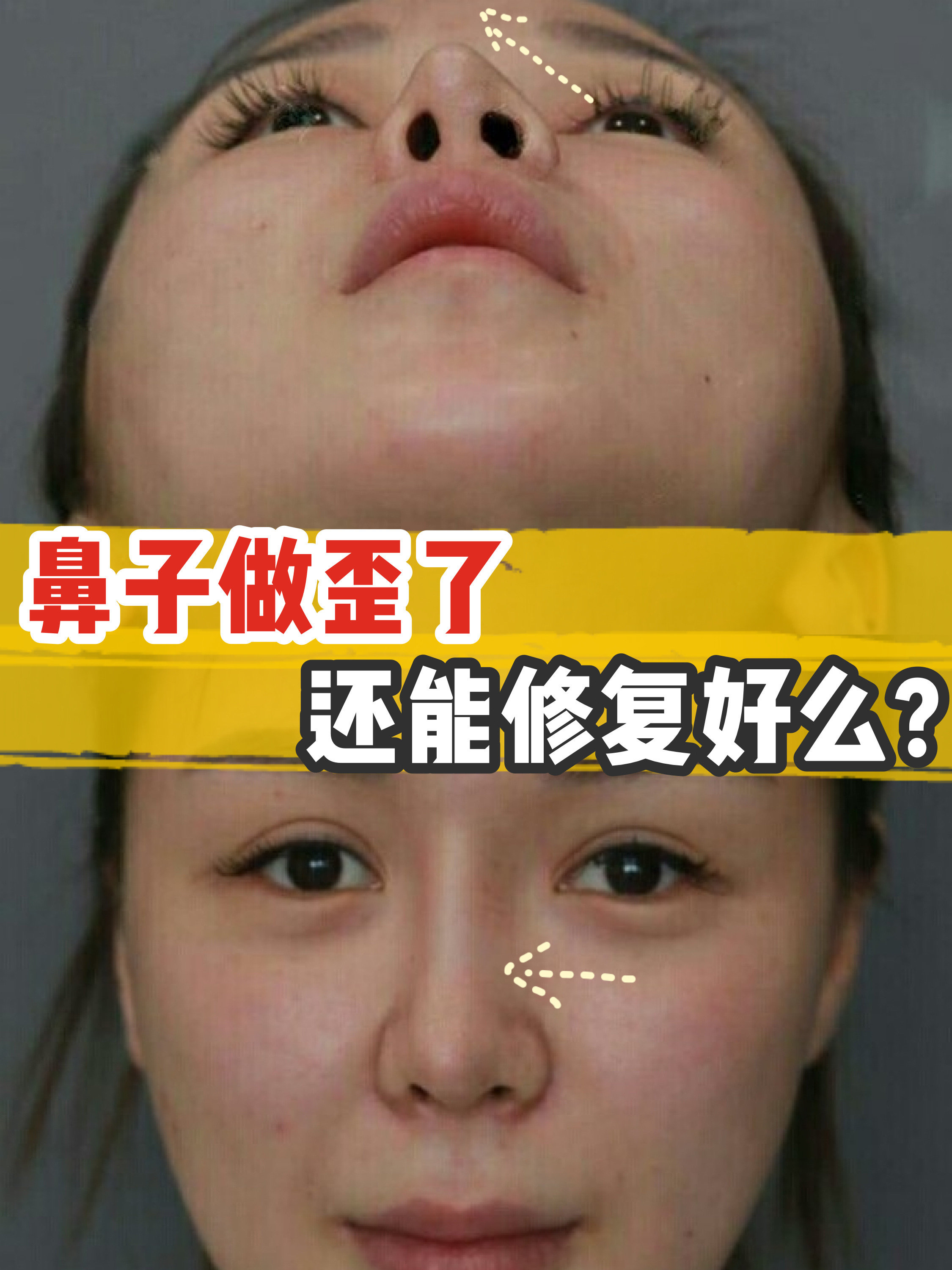 【投稿】98之前做过l型硅胶假体隆鼻,去年五一节前去_圈子-新氧美容