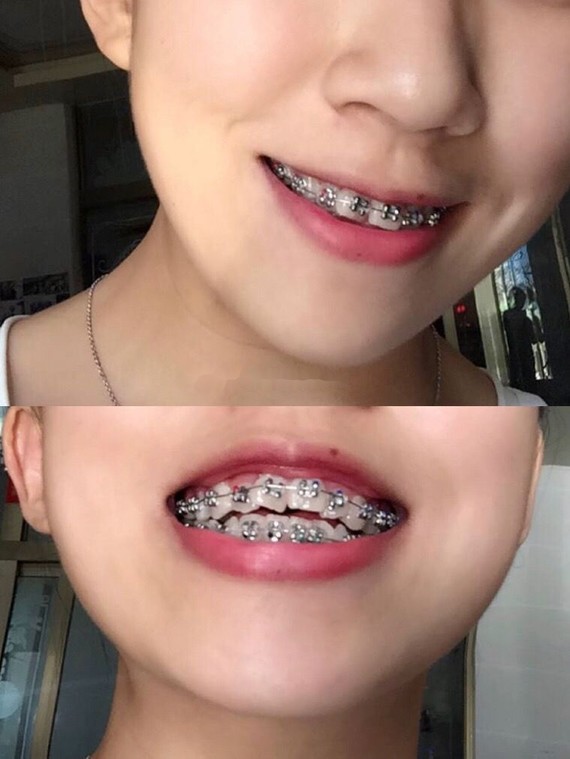 广州牙齿正畸案例:自身牙齿小龅牙,加上牙齿排列不齐_圈子-新氧美容