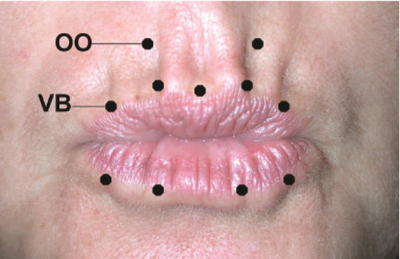 【变美功课】肉毒素用于去口周纹