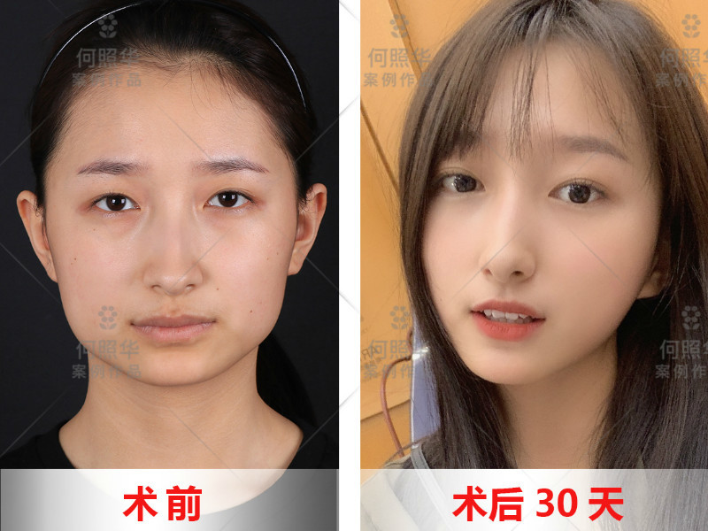 下颌角肥大该怎么办 我和男朋友相处了 新氧美容整形 下颌角肥大该怎么办 我和男朋友相处了 新氧美容整形