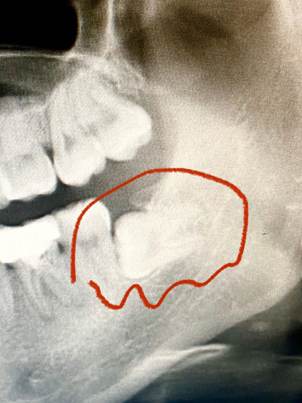 拔完四颗智齿后,总结的一些小建议～分享一个小姐姐拔_圈子-新氧美容