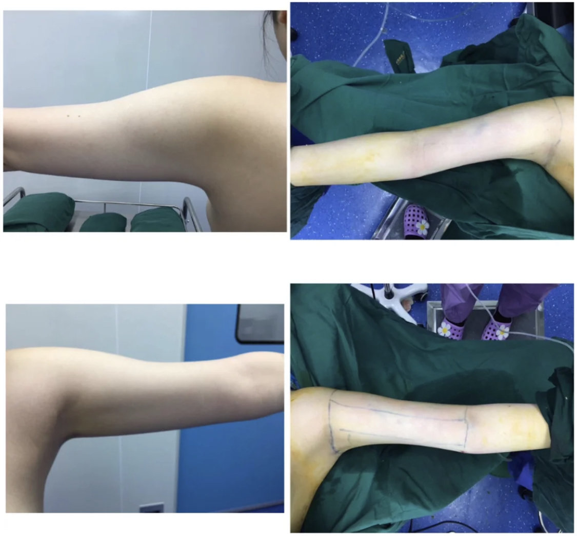 吸脂后塑身衣穿的越紧越好吗?