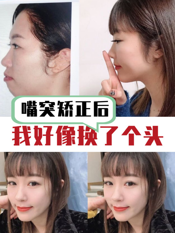 广州龅牙矫正案例分享:牙齿矫正过程中牙齿也会往回收_圈子-新氧美容