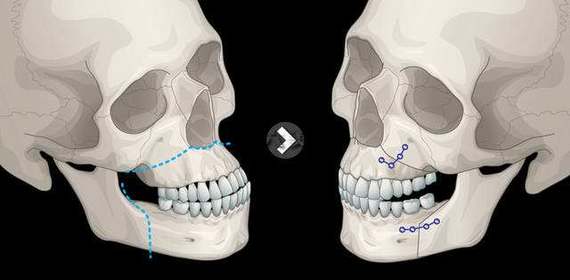 为什么有些人会说:我连死都不怕,还怕整形吗?