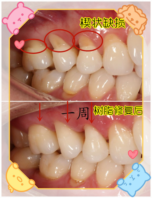 我用舌头舔的牙齿根部上有个小凹陷是什么东西啊