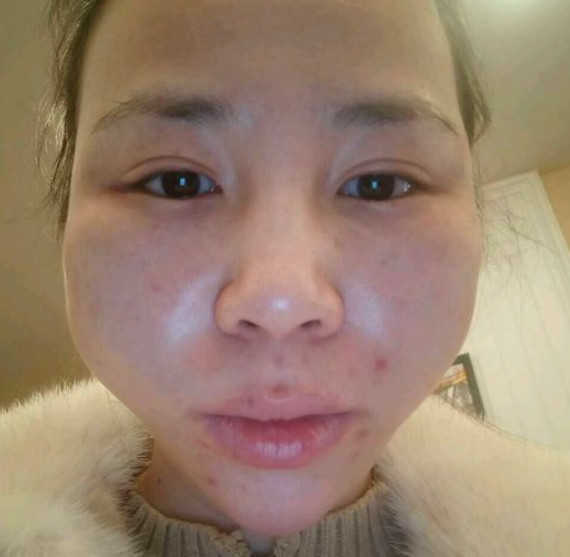 线雕几天消肿脸部线雕40天还肿是咋回事我怂了