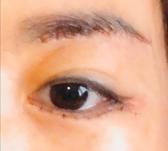 强势围观!"豆眼妹"切眉前后对比图,做切眉手术恢复期得多久?