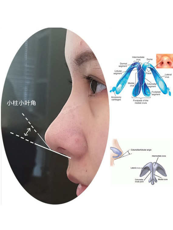 自然鼻尖的特点之一小柱小叶转折