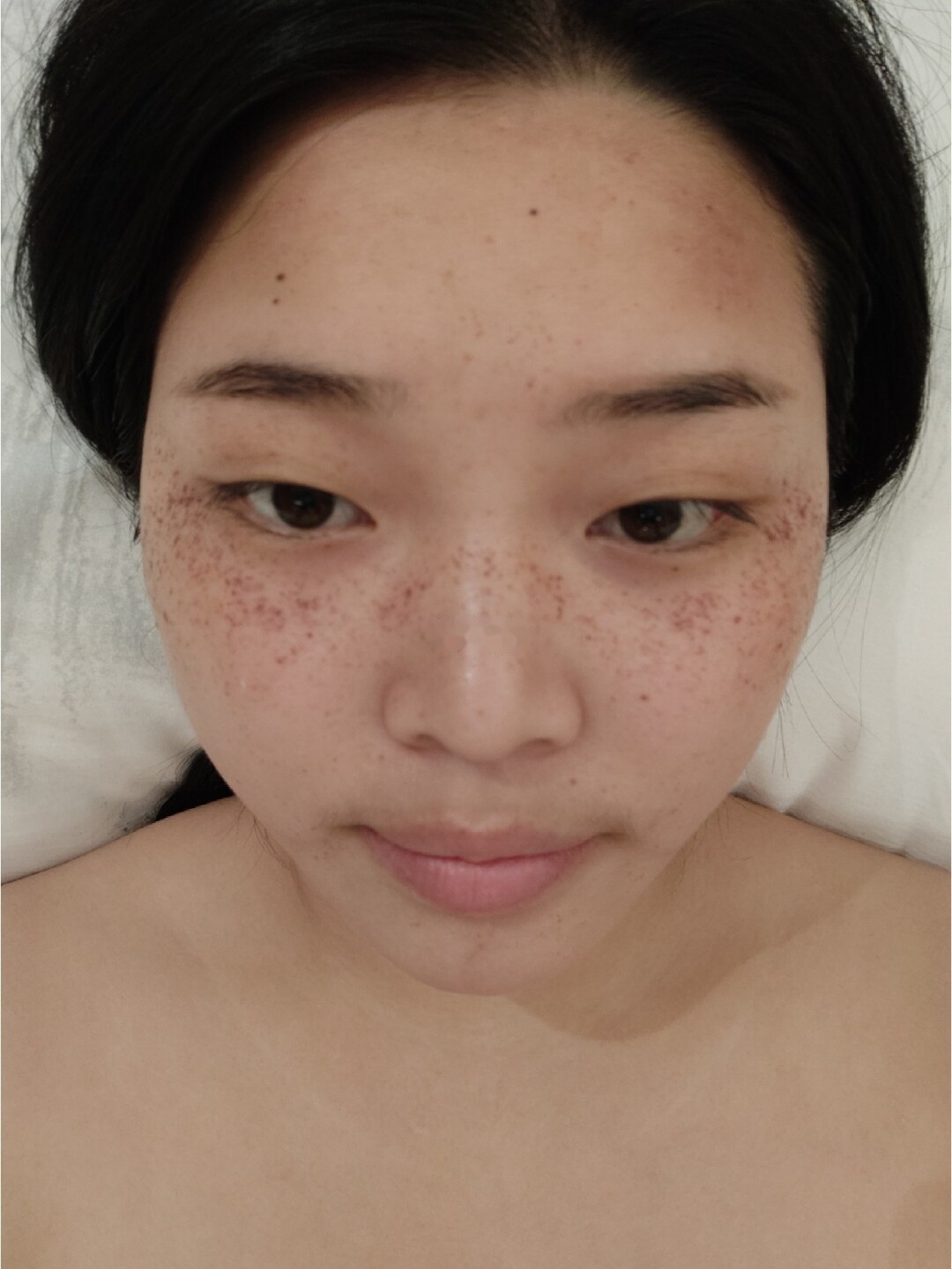一次皮秒的雀斑第一天刚开始做雀斑的时候,有微微的刺_圈子-新氧美容