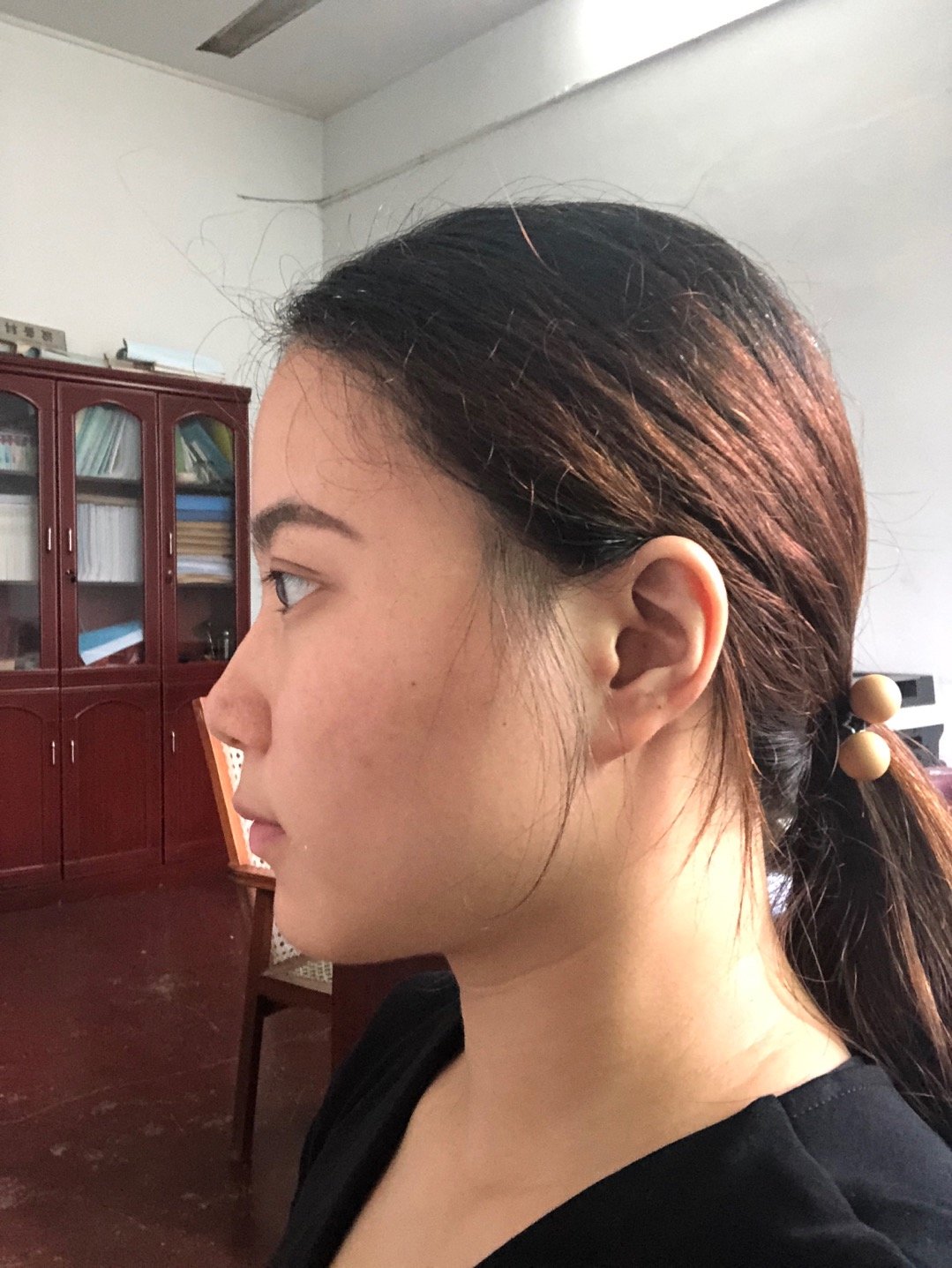 颧骨高鼻基底低鼻梁太矮要不要做个鼻部多项