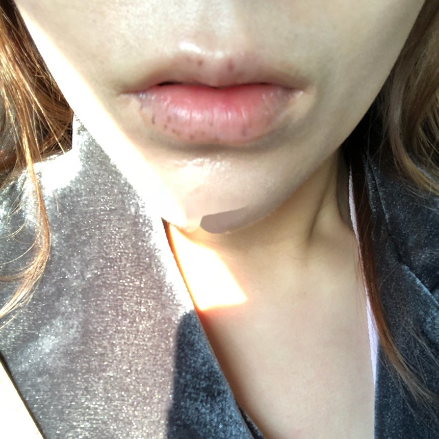 激光祛唇斑无美颜无滤镜真实分享激光祛唇斑_圈子-新氧美容整形