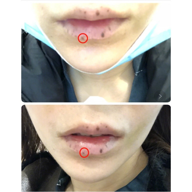 激光祛唇斑无美颜无滤镜真实分享激光祛唇斑_圈子-新氧美容整形