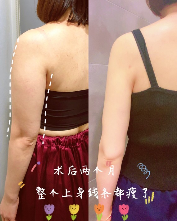 又因为手臂的脂肪一般以浅层脂肪为主,所以小臂不容易形成堆积,所以