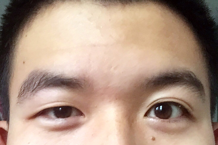 两支眼睛不一样大小可以做一只眼睛吗