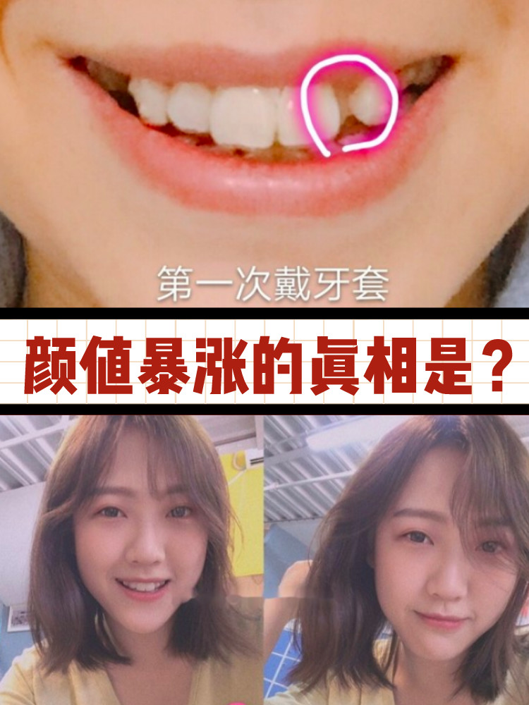 牙齿正畸告别虎牙妹!有木有跟我一样小虎牙?