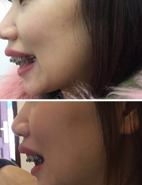 无锡牙齿正畸投稿:张嘴上牙盖住了下牙,还是龅牙,凸_圈子-新氧美容