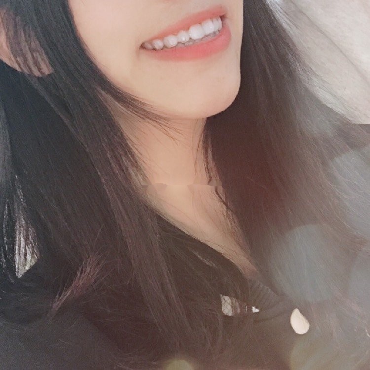 戴牙套一年,我最喜欢的就是露牙笑~分享小仙女正畸经_圈子-新氧美容整