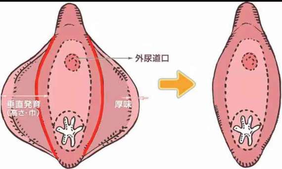 你好, 正常情況下小陰唇兩側能夠自然合攏,遮擋著陰道口和尿道口