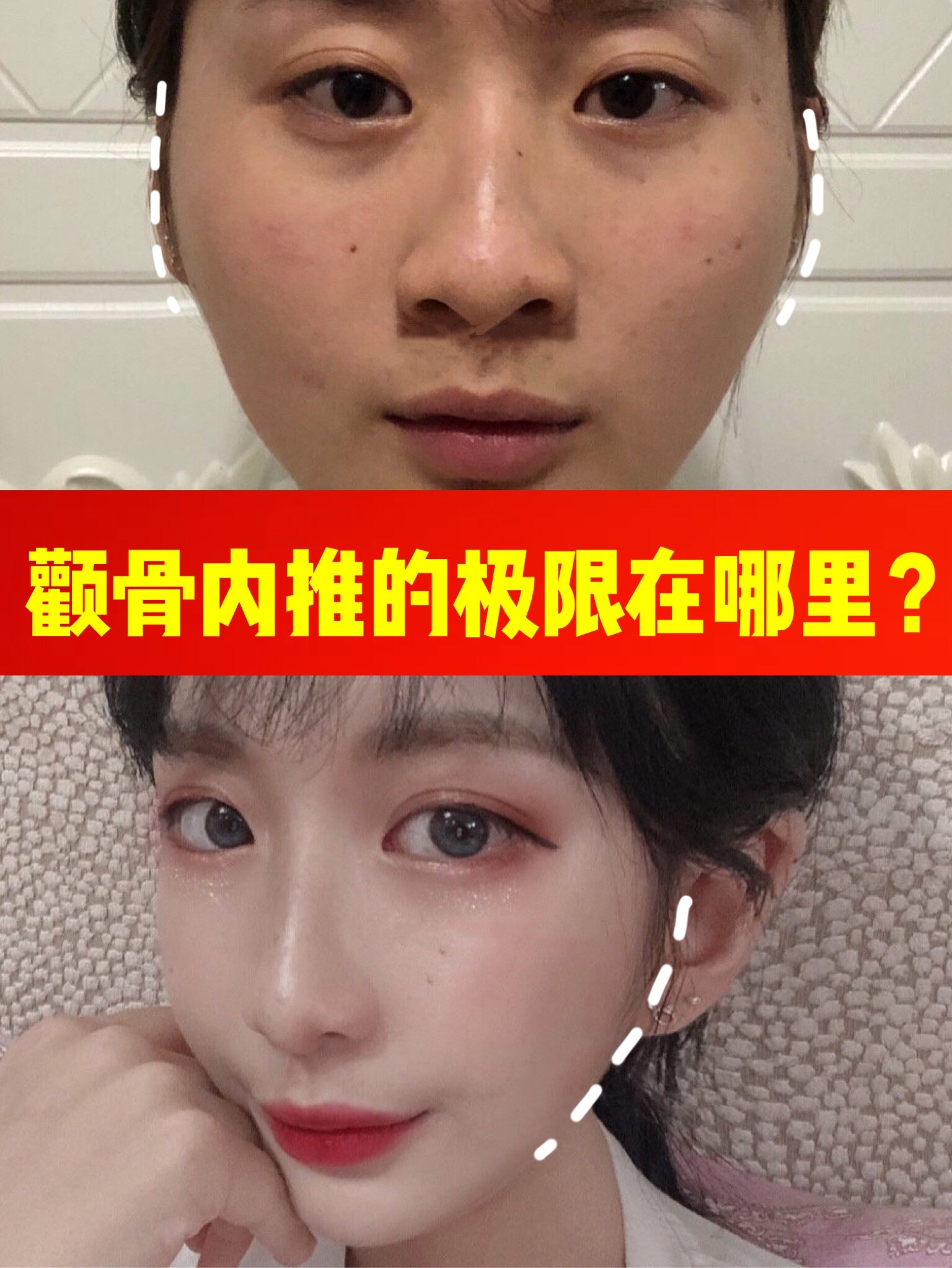颧骨内推的极限在哪里7571