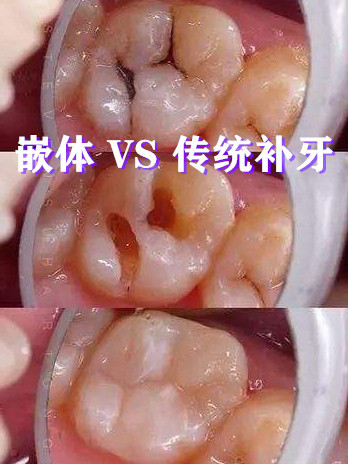 嵌体vs 传统补牙