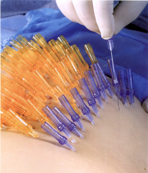 线雕断线后有什么症状?